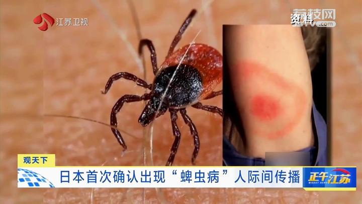 观天下丨日本首次确认出现蜱虫病人际间传播