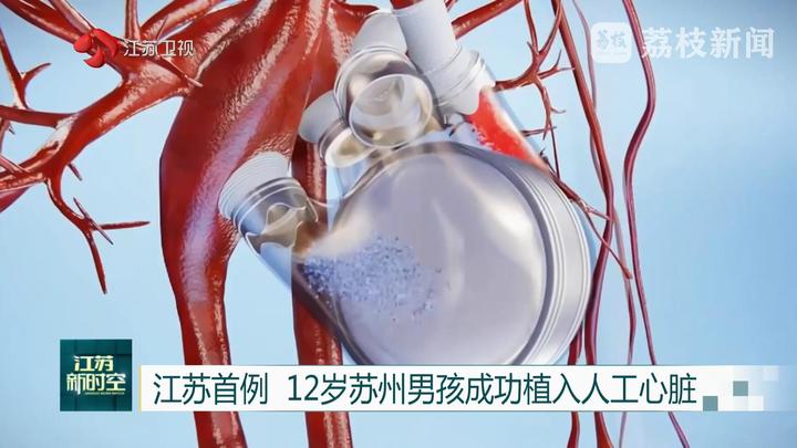 江苏首例 12岁苏州男孩成功植入人工心脏_荔枝新闻