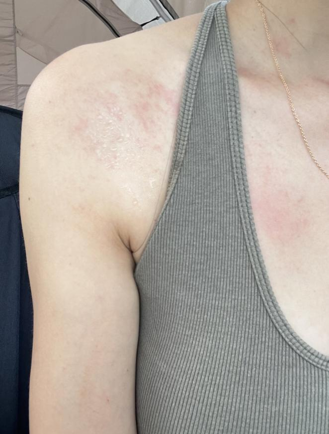 春游后身上莫名冒出红疙瘩?原因竟是……